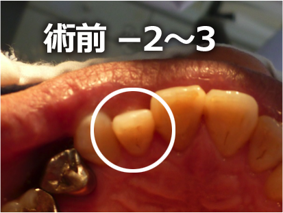 なるべく削らない最新虫歯治療その1