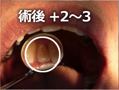なるべく削らない最新虫歯治療その1